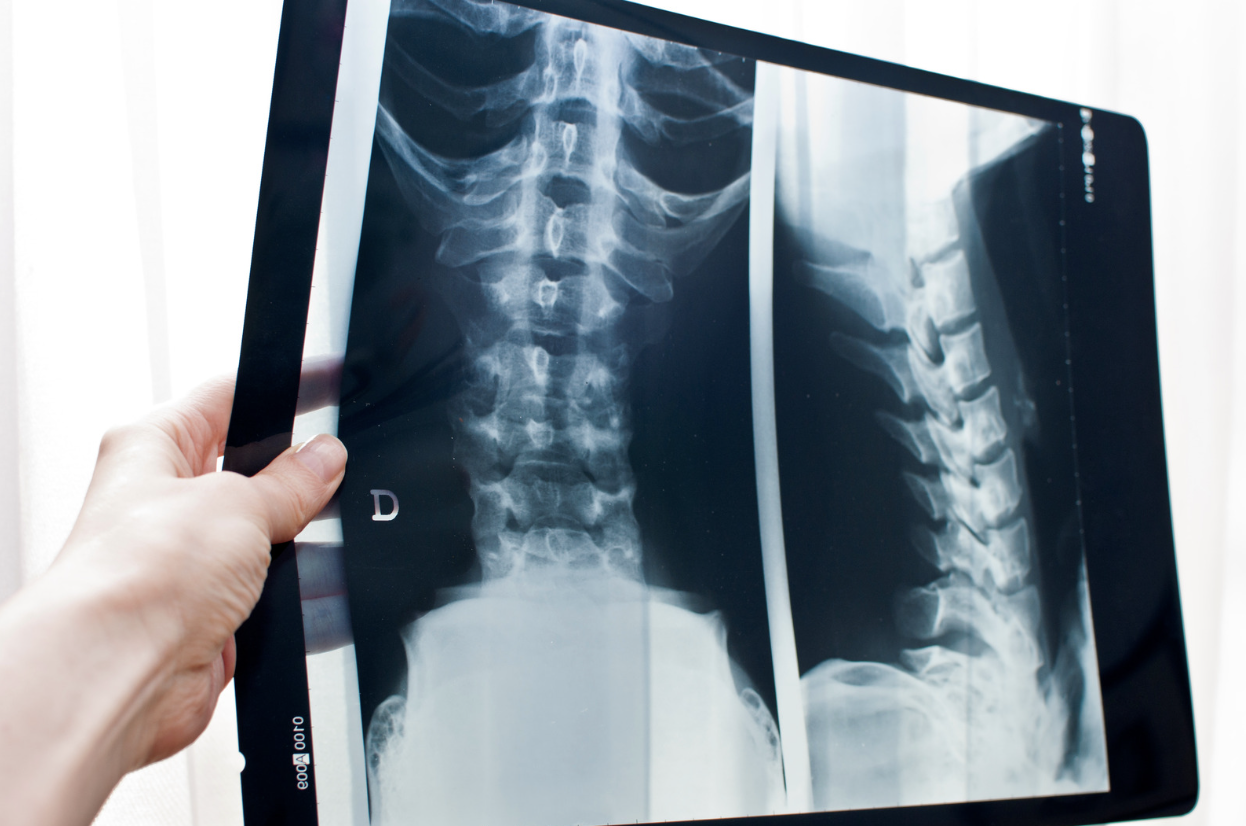 spinal-x-ray-as-evidence-for-disability.png